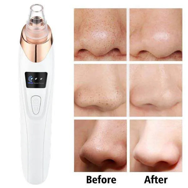 Electric Blackhead Remover Vacuum with 5 Interchangeable Suction Heads